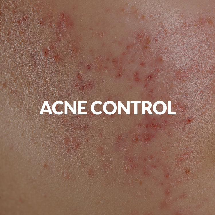 Acne Control
