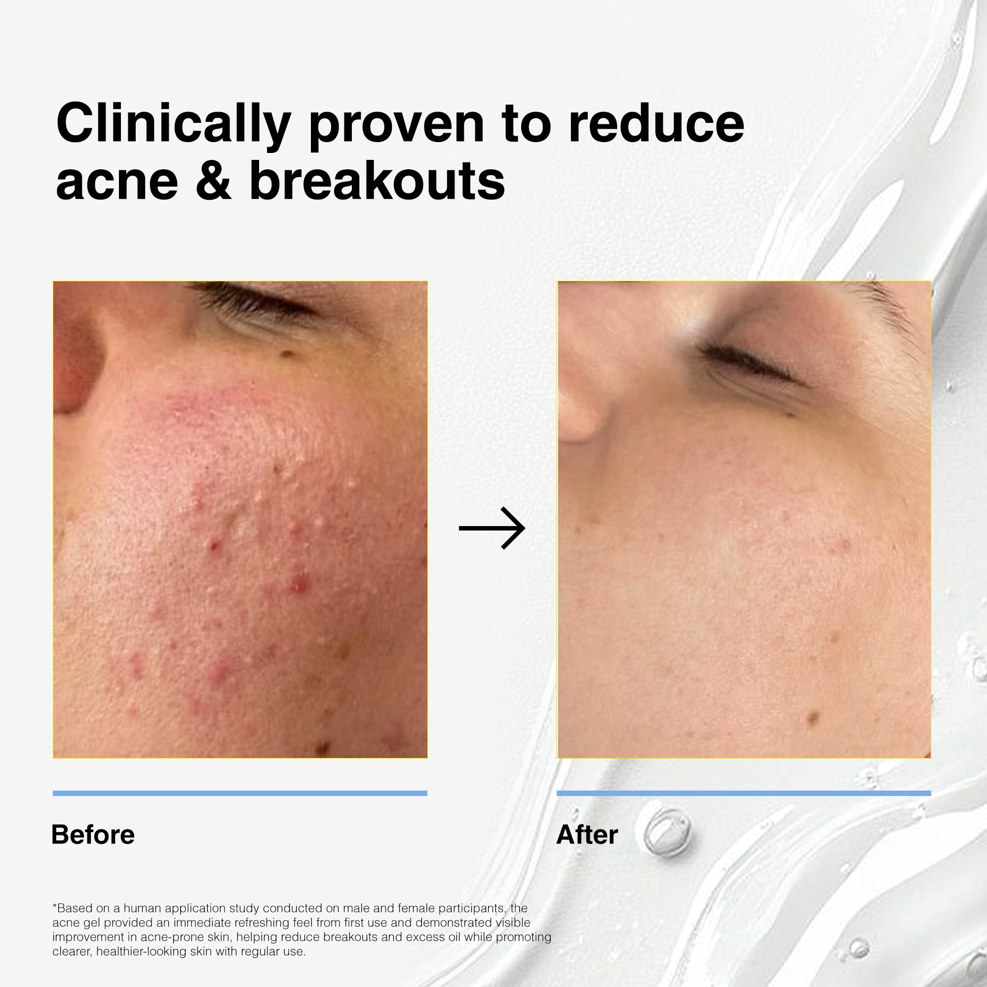 Salicylic Acid Face Cleanser | Oil Control & Acne-Fighting Formul