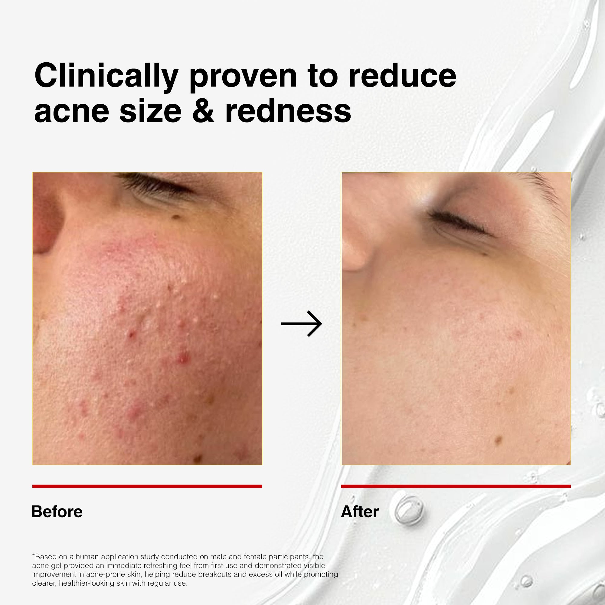 Corrector Gel | Soothing Formula for Acne-Prone Skin